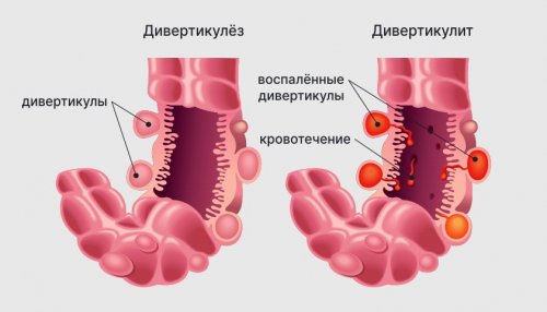 Ишемия кишки