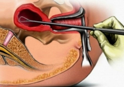 Выскабливание цервикального канала